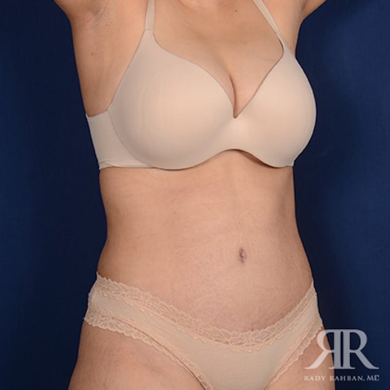 Tummy Tuck Before & After Gallery - Patient 429080 - Image 4