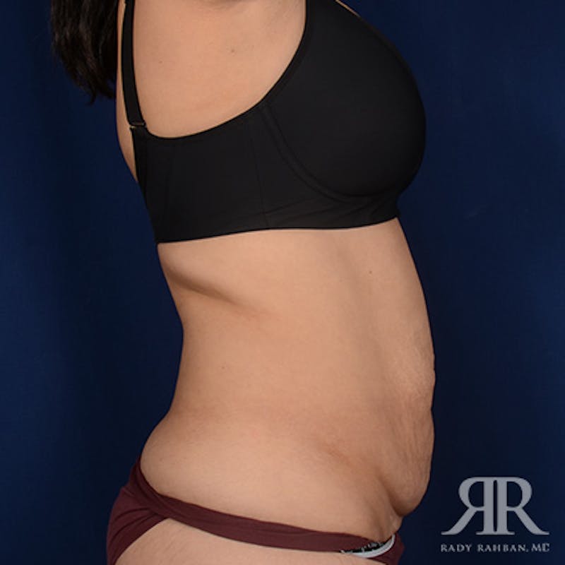 Tummy Tuck Before & After Gallery - Patient 429080 - Image 5