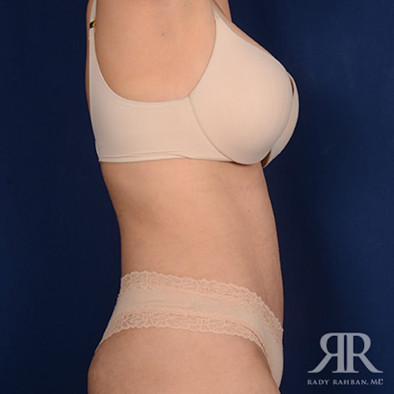 Tummy Tuck Before & After Gallery - Patient 429080 - Image 6