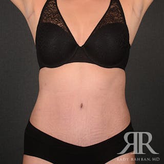 Tummy Tuck Before & After Gallery - Patient 160258 - Image 2