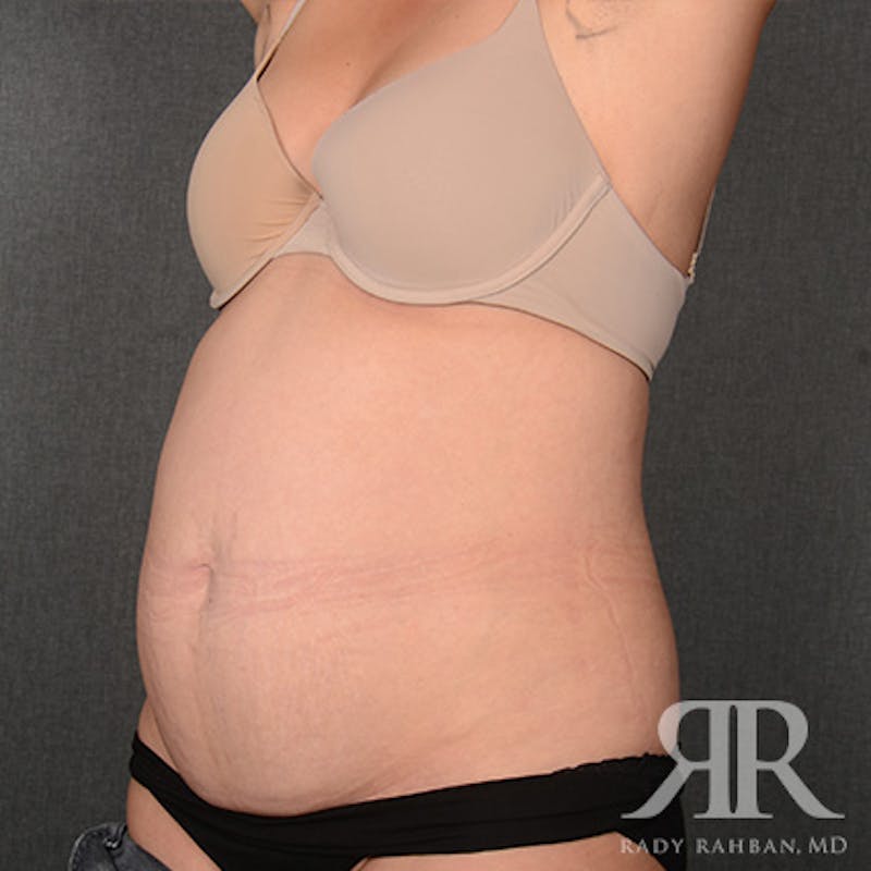 Tummy Tuck Before & After Gallery - Patient 160258 - Image 3