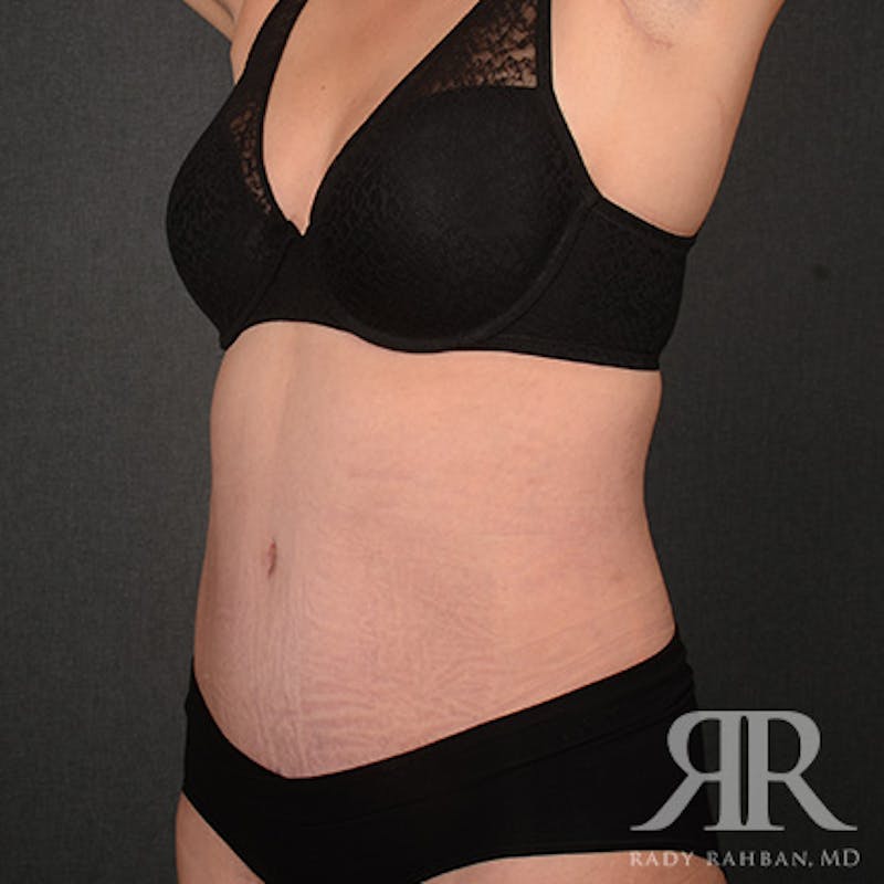 Tummy Tuck Before & After Gallery - Patient 160258 - Image 4