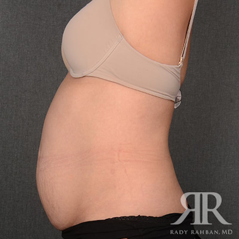 Tummy Tuck Before & After Gallery - Patient 160258 - Image 5