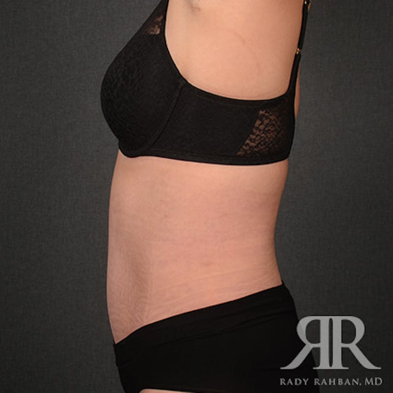 Tummy Tuck Before & After Gallery - Patient 160258 - Image 6