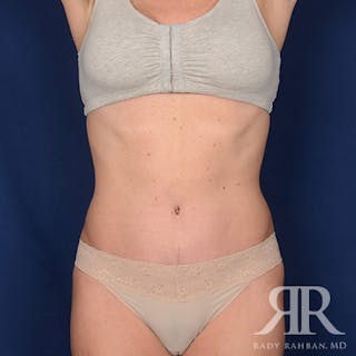 Tummy Tuck Before & After Gallery - Patient 190618 - Image 2