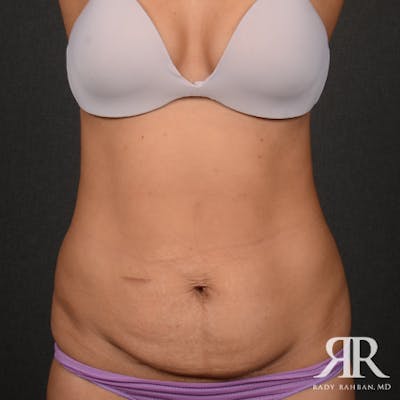 Tummy Tuck Before & After Gallery - Patient 308728 - Image 1