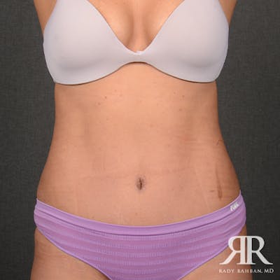 Tummy Tuck Before & After Gallery - Patient 308728 - Image 2