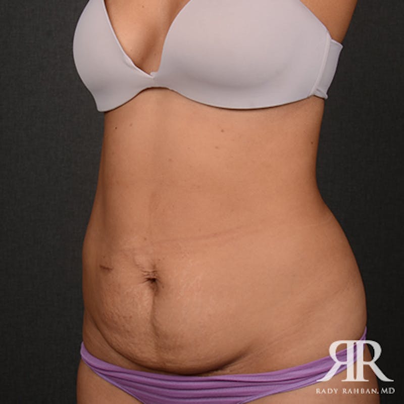 Tummy Tuck Before & After Gallery - Patient 308728 - Image 3