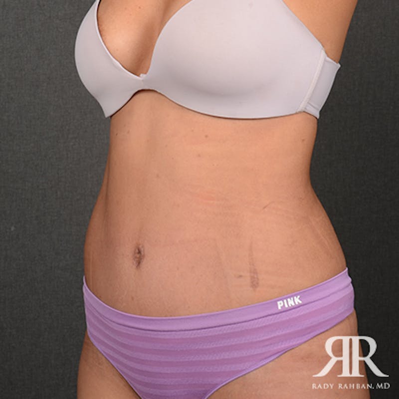 Tummy Tuck Before & After Gallery - Patient 308728 - Image 4