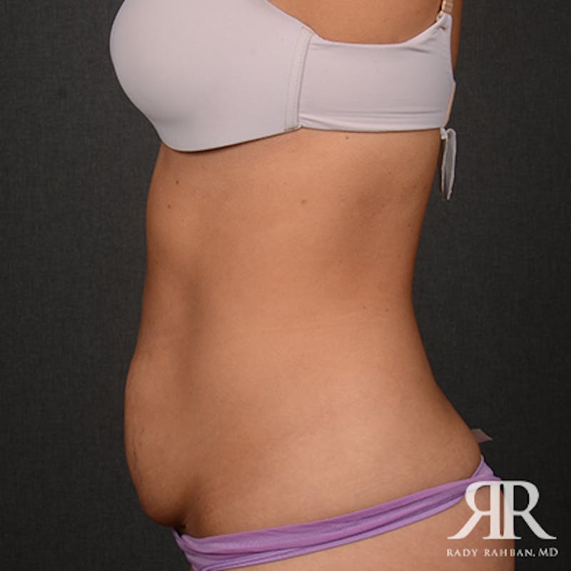 Tummy Tuck Before & After Gallery - Patient 308728 - Image 5