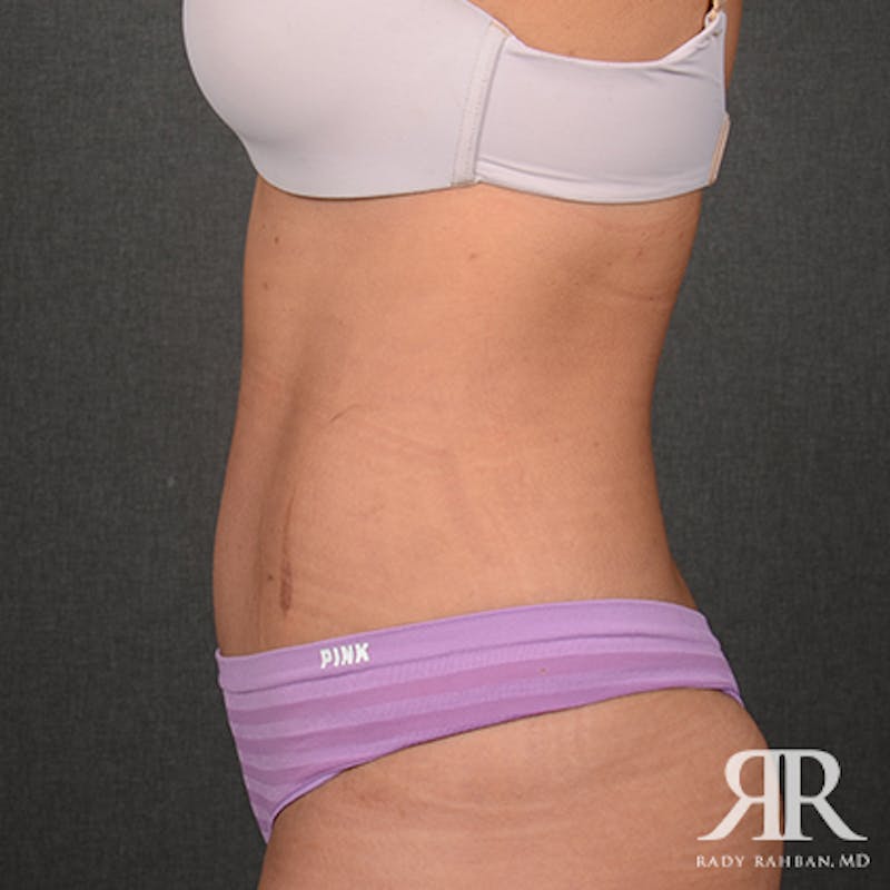 Tummy Tuck Before & After Gallery - Patient 308728 - Image 6