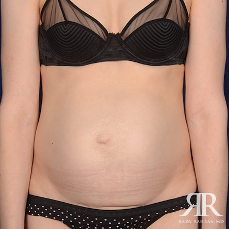 Tummy Tuck Before & After Gallery - Patient 271850 - Image 1
