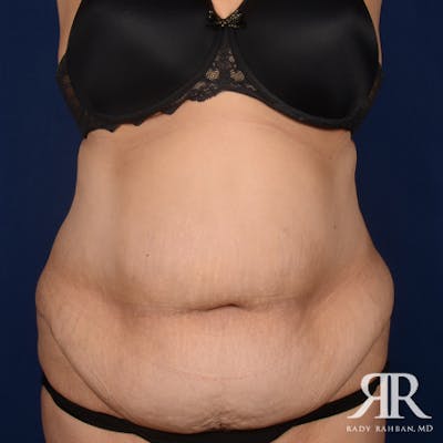 Tummy Tuck Before & After Gallery - Patient 162970 - Image 1