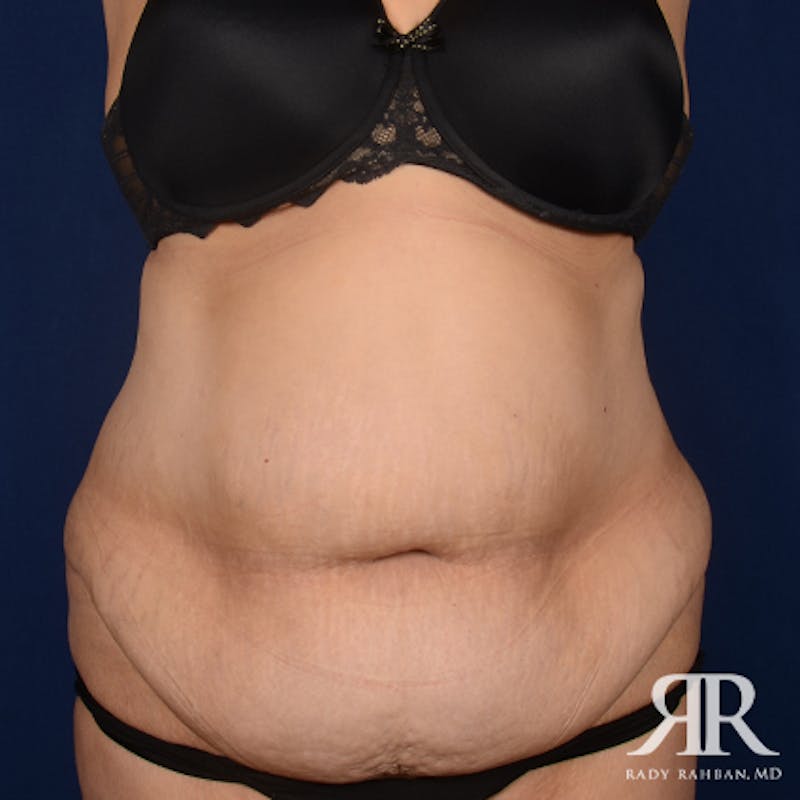 Tummy Tuck Before & After Gallery - Patient 162970 - Image 1