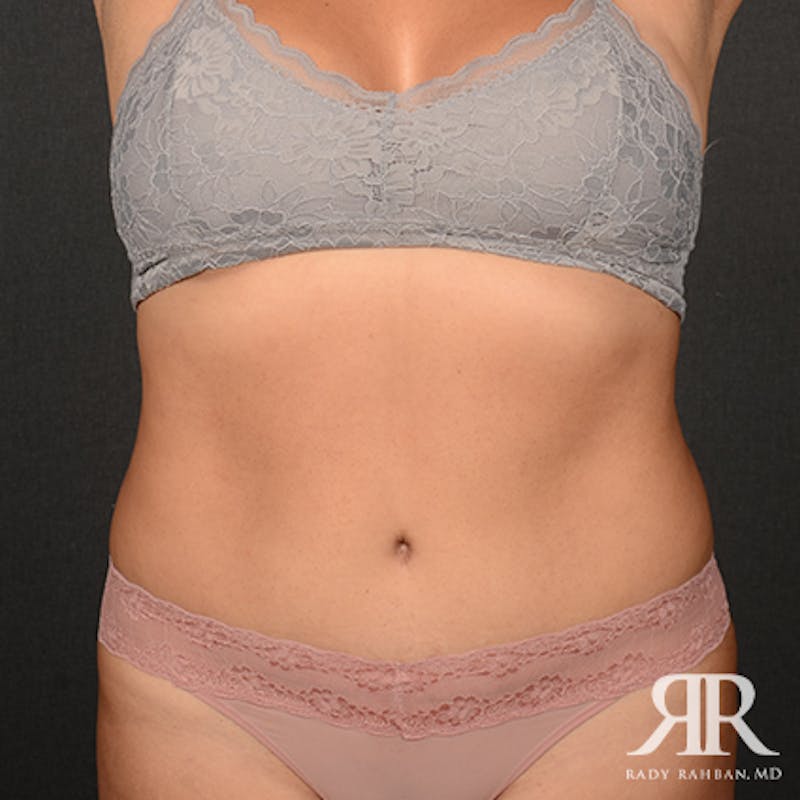 Tummy Tuck Before & After Gallery - Patient 162970 - Image 2