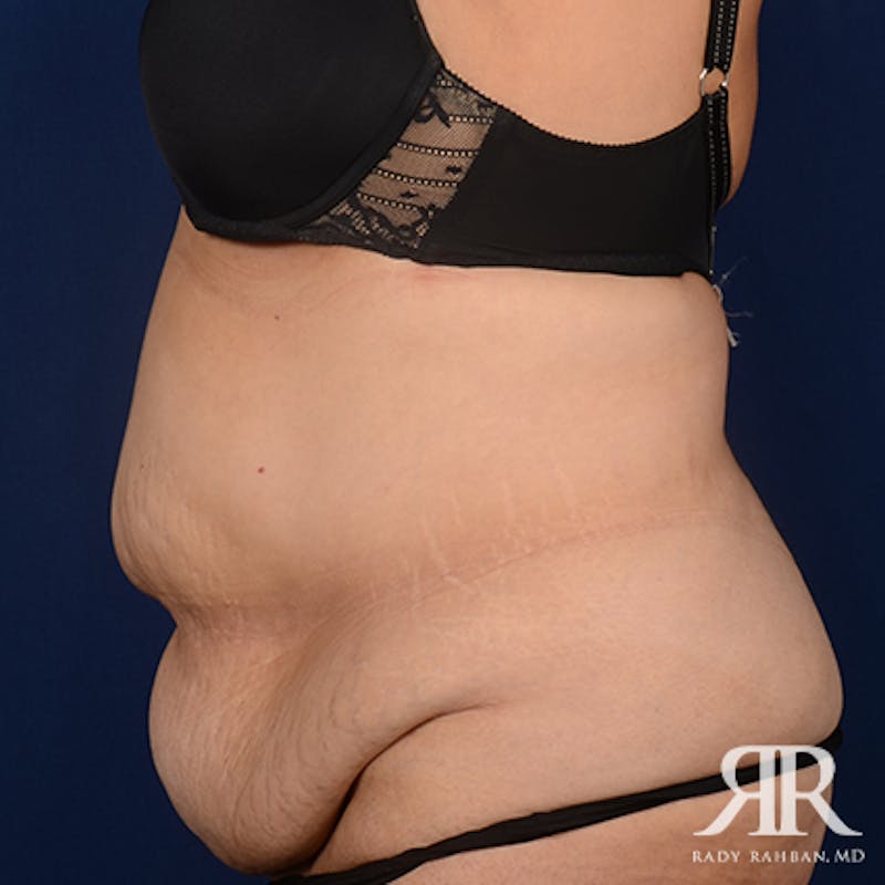 Tummy Tuck Before & After Gallery - Patient 162970 - Image 5