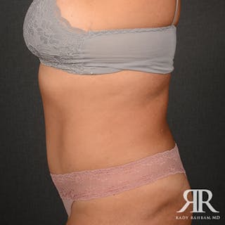 Tummy Tuck Before & After Gallery - Patient 162970 - Image 6