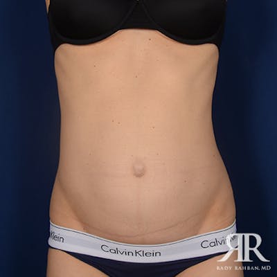 Tummy Tuck Before & After Gallery - Patient 307918 - Image 1