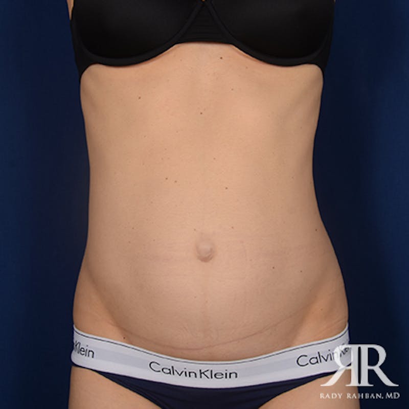 Tummy Tuck Before & After Gallery - Patient 307918 - Image 1