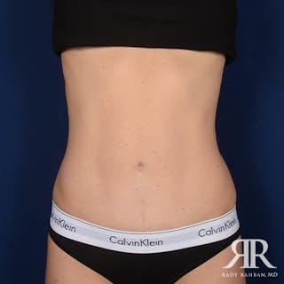 Tummy Tuck Before & After Gallery - Patient 307918 - Image 2