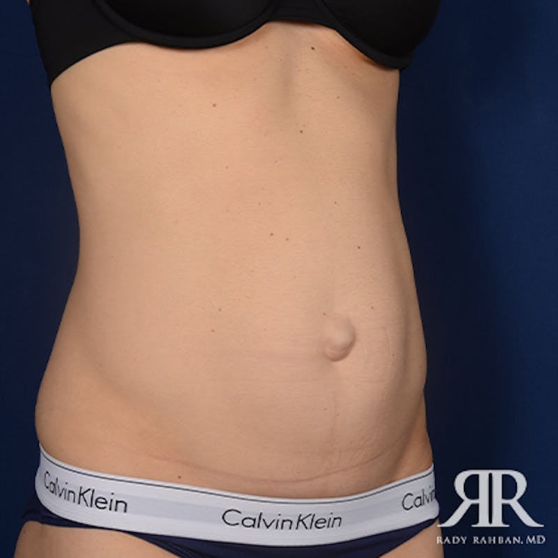Tummy Tuck Before & After Gallery - Patient 307918 - Image 3