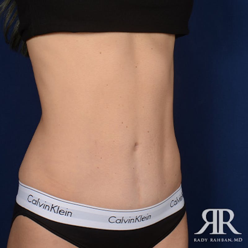 Tummy Tuck Before & After Gallery - Patient 307918 - Image 4