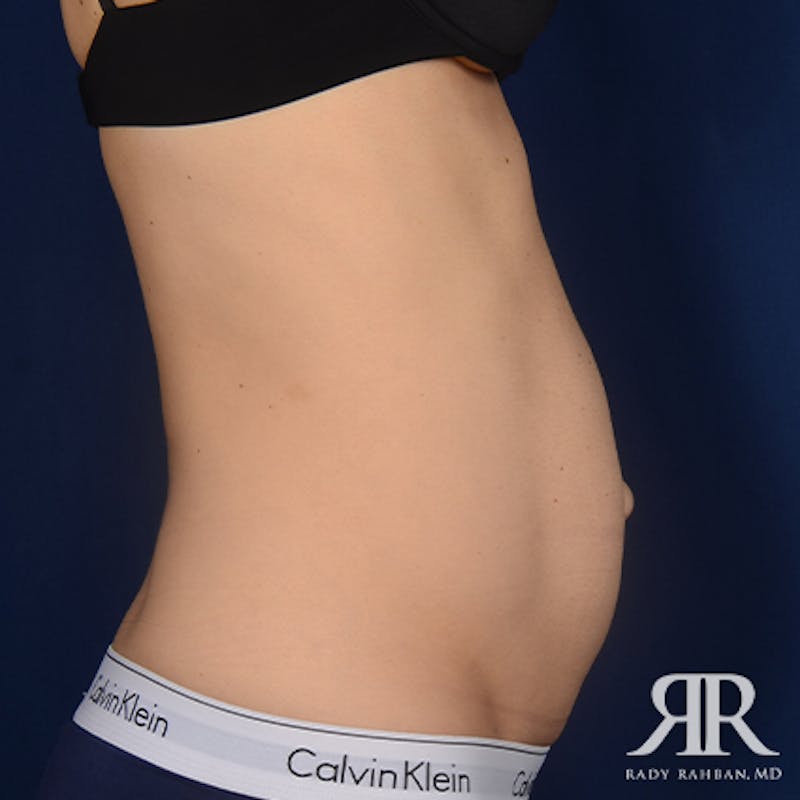 Tummy Tuck Before & After Gallery - Patient 307918 - Image 5