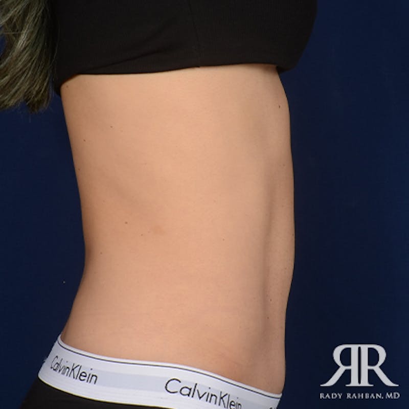Tummy Tuck Before & After Gallery - Patient 307918 - Image 6