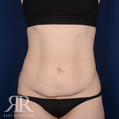 Tummy Tuck Before & After Gallery - Patient 131488 - Image 1