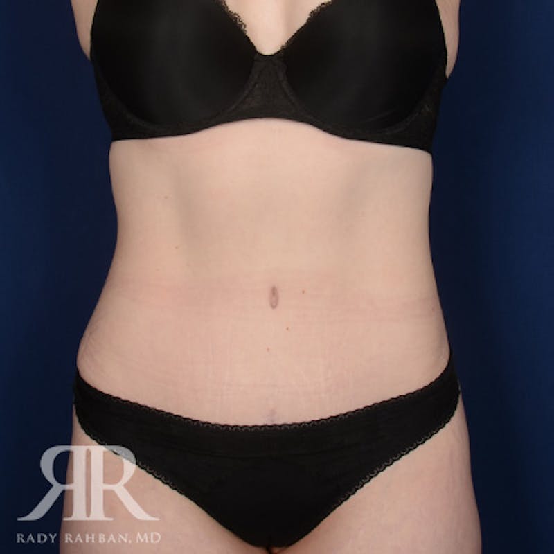 Tummy Tuck Before & After Gallery - Patient 131488 - Image 2