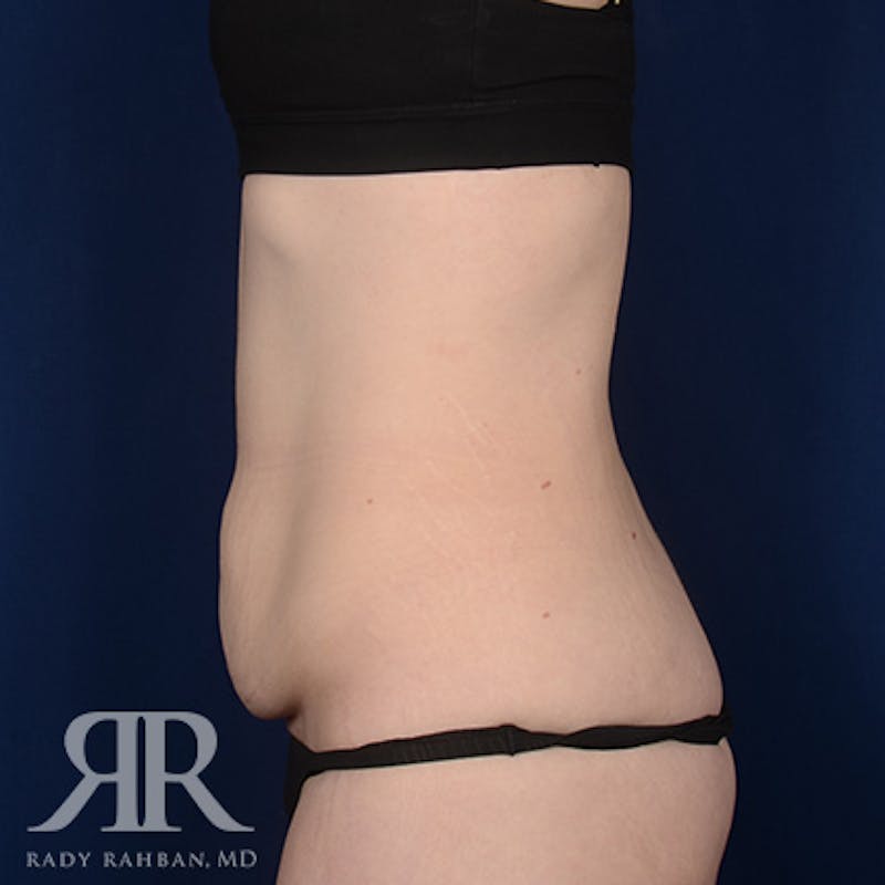 Tummy Tuck Before & After Gallery - Patient 131488 - Image 5