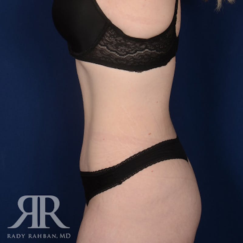 Tummy Tuck Before & After Gallery - Patient 131488 - Image 6