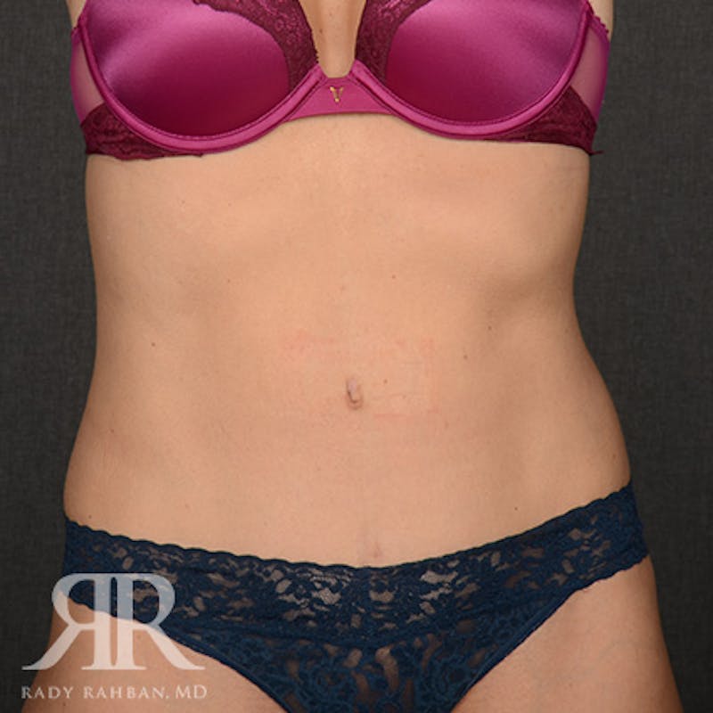 Tummy Tuck Before & After Gallery - Patient 386879 - Image 2