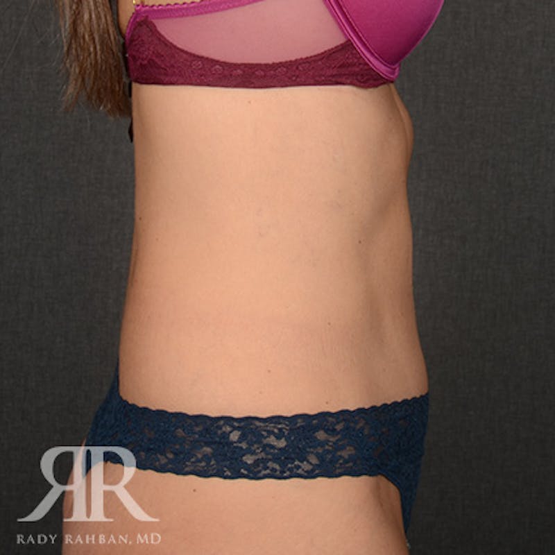 Tummy Tuck Before & After Gallery - Patient 386879 - Image 6