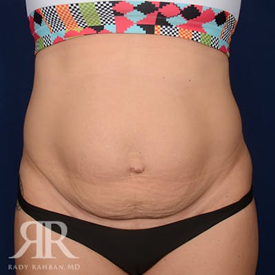 Tummy Tuck Before & After Gallery - Patient 231979 - Image 1