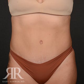 Tummy Tuck Before & After Gallery - Patient 231979 - Image 2