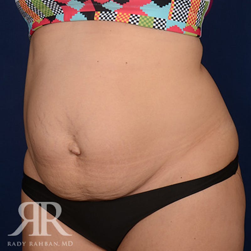 Tummy Tuck Before & After Gallery - Patient 231979 - Image 3