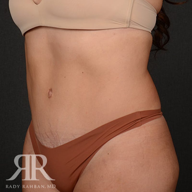 Tummy Tuck Before & After Gallery - Patient 231979 - Image 4