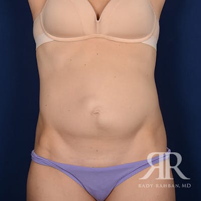 Tummy Tuck Before & After Gallery - Patient 413628 - Image 1