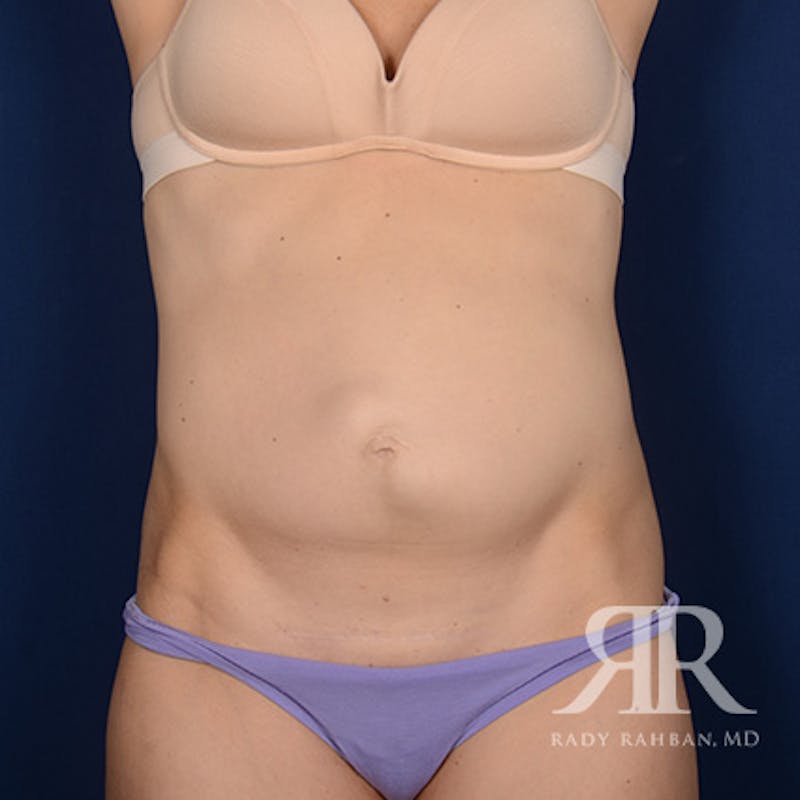 Tummy Tuck Before & After Gallery - Patient 413628 - Image 1