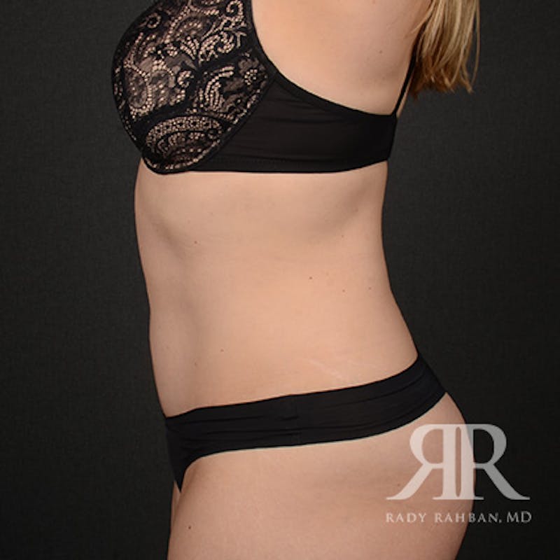 Tummy Tuck Before & After Gallery - Patient 413628 - Image 6