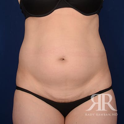 Tummy Tuck Before & After Gallery - Patient 800744 - Image 1