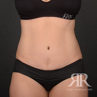 Tummy Tuck Before & After Gallery - Patient 800744 - Image 2