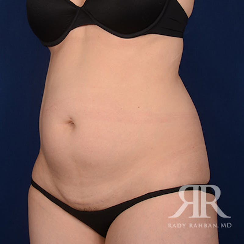 Tummy Tuck Before & After Gallery - Patient 800744 - Image 3