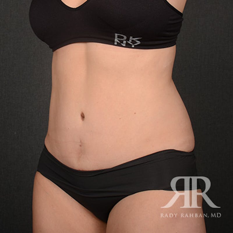 Tummy Tuck Before & After Gallery - Patient 800744 - Image 4