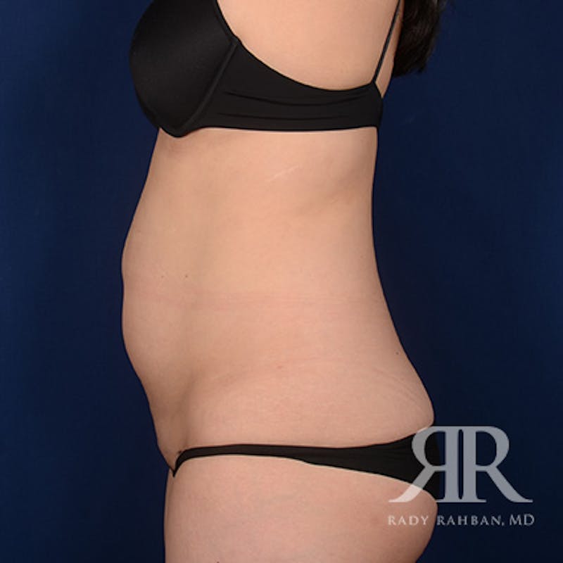Tummy Tuck Before & After Gallery - Patient 800744 - Image 5