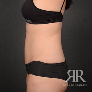 Tummy Tuck Before & After Gallery - Patient 800744 - Image 6