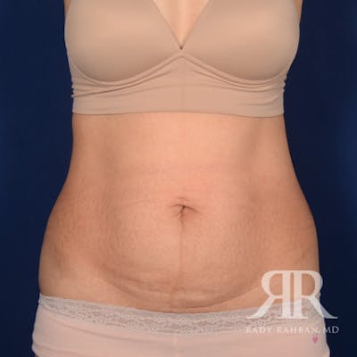 Tummy Tuck Before & After Gallery - Patient 208625 - Image 1
