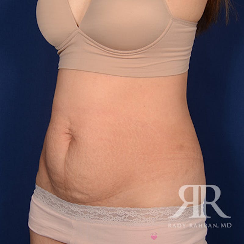 Tummy Tuck Before & After Gallery - Patient 208625 - Image 3
