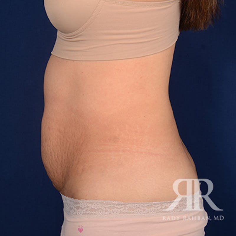 Tummy Tuck Before & After Gallery - Patient 208625 - Image 5